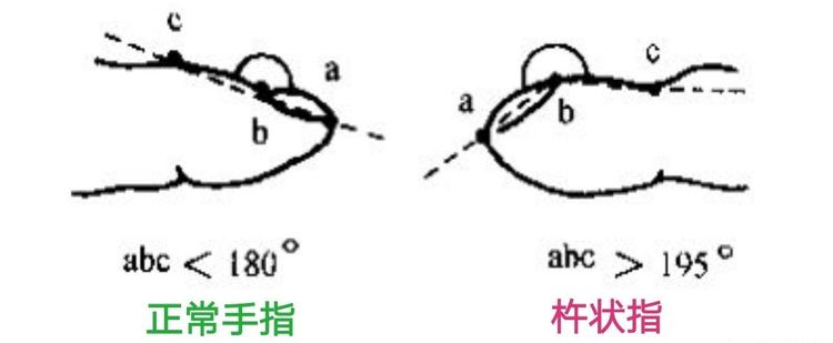 杵状指常用的具体测量方法如下: 1. 甲上角测量法