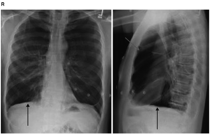 图4-10 胸片显示肺气肿:透亮度增高,膈肌低平(黑箭头),胸片前后径增大