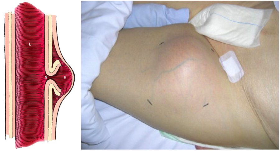 股动脉假性动脉瘤,冠脉介入的