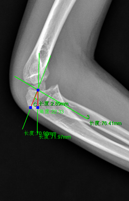 正常肘关节侧位片上,肘关节囊前后都有脂肪组织,充填于鹰嘴窝,喙突