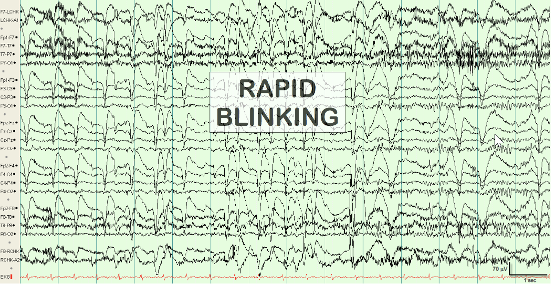 清醒期持续右向水平眼震(nystagmus),频率在4hz左右,在双侧额极及前