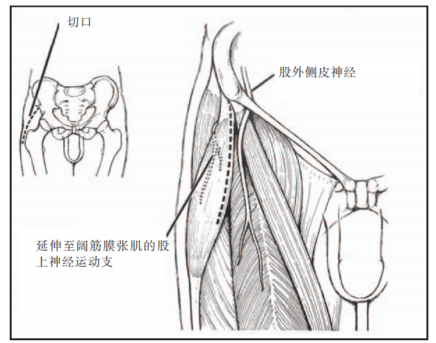 髋关节直接前方入路,髋臼及股骨的暴露和准备|临床实战