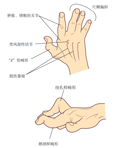 肌肉萎缩.   后期阶段:关节畸形,半脱位,不稳定或强直.