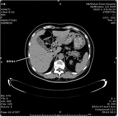 腹部ct(提示胆囊结石)