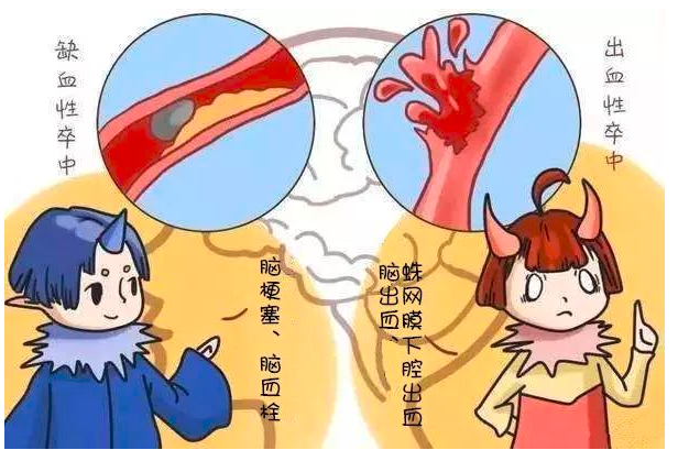 我叫"脑卒中",离你们并不远_脑卒中_危险因素_二级_医