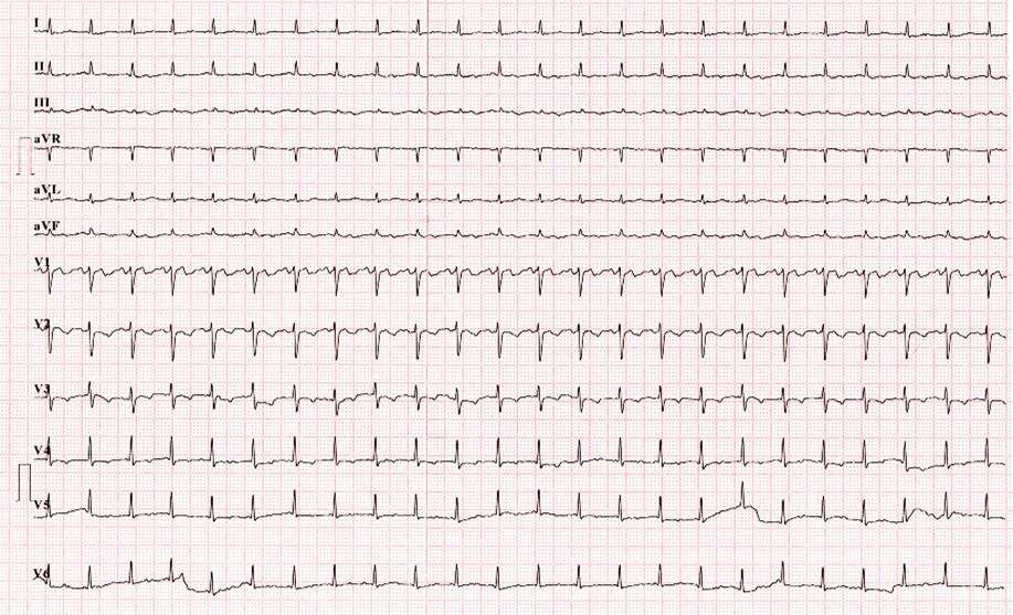 心电图提示不典型房扑伴2:1房室下传(图1),心电监护显示其心率波动于
