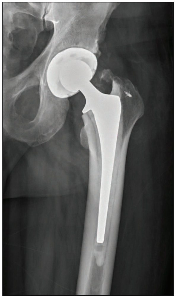 6 73岁男性患者术中出现大转子骨折的术后照片,其使用带线锚钉内固定