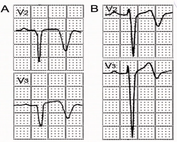 双向 上述情况均不伴有qrs波形态改变和st段显著偏移   (2)心电图改变