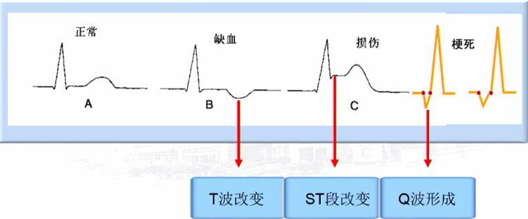 心肌缺血,损伤及梗死的心电图表现