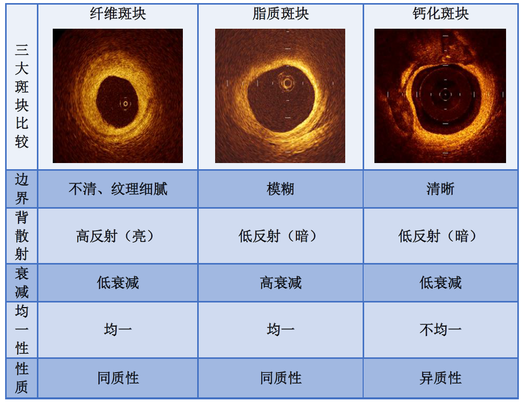② 脂质斑块(lipid plaque,图7)     ③ 钙化斑块(calcified