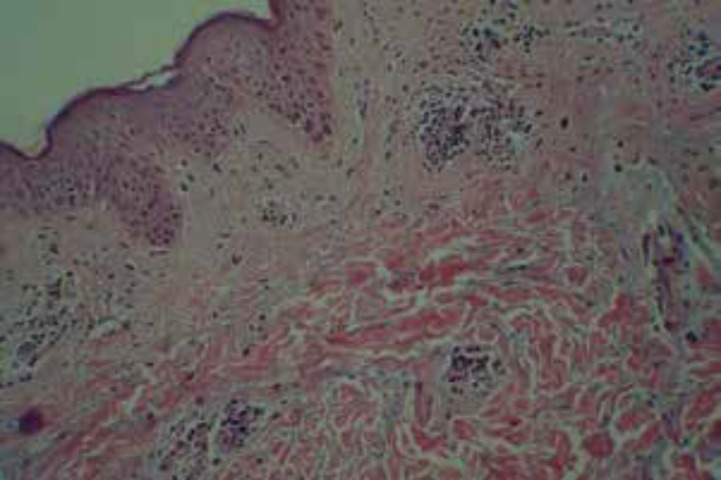图2皮肤活检显示轻度苔藓样反应,真皮层血管周围慢性炎性细胞浸润